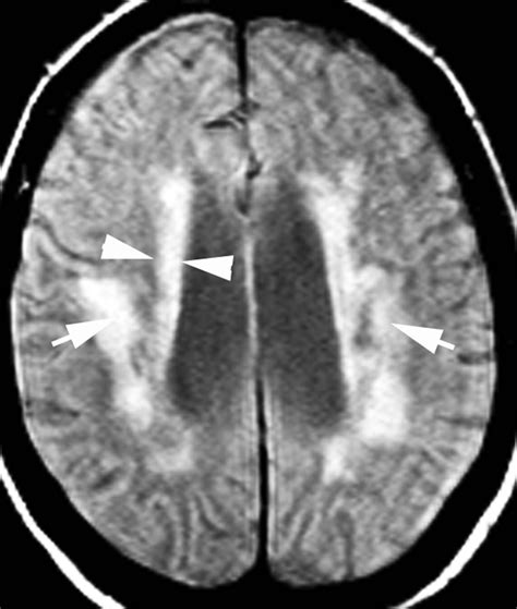 periventricular white matter - eaparaphrasings