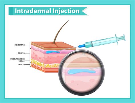Intradermal Injection Sites