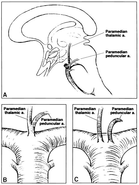 Vertical Gaze Palsies From Medial Thalamic Infarctions Without Midbrain ...