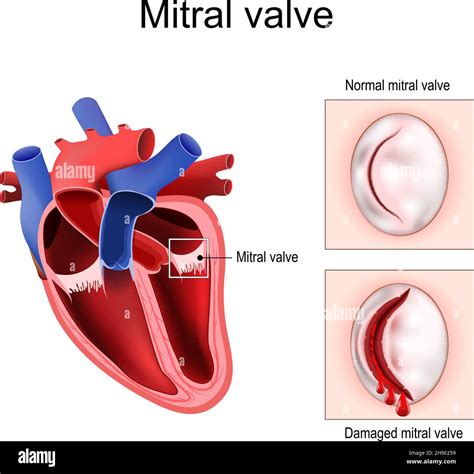 What Happens When A Heart Valve Closes at Terry Haskell blog