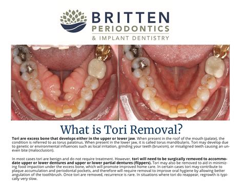 What is Tori Removal? - Britten Perio