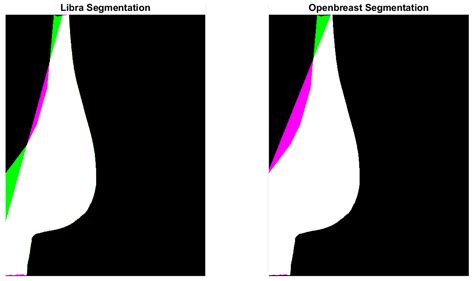 A Machine Learning Approach for Breast Cancer Risk Prediction in ...