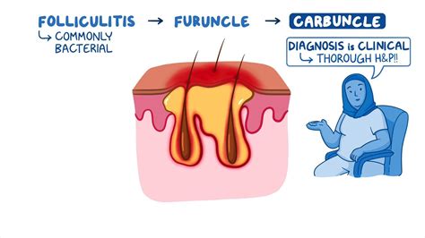 Carbuncles Youtube Carbuncle | Rotten Tomatoes