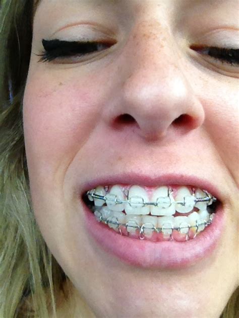 Wiring Jaw Shut For Weight Loss