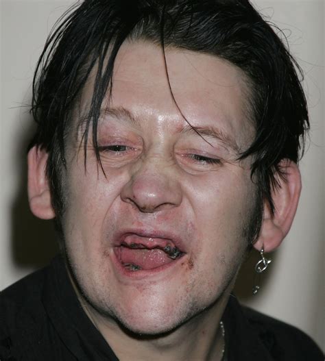 Shane Macgowan New Teeth