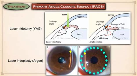 Primary Angle Closure Glaucoma | PPT | Free Download