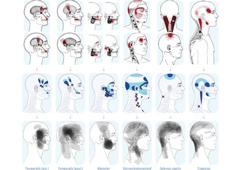 Referred Pain: What It Is and How to Treat It. - Gellini
