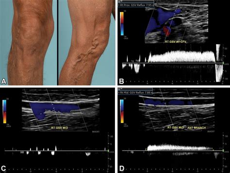 Vascular Ultrasound Of Legs