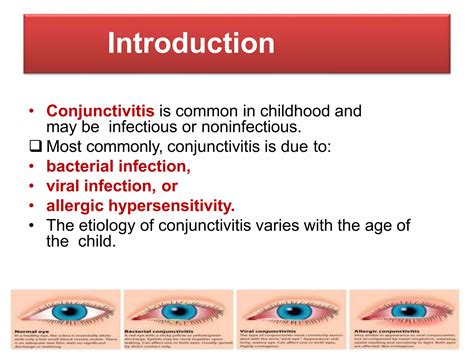 Bacterial vs Viral Conjunctivitis: Signs, Symptoms and Treatment | PPT