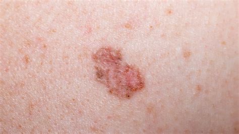 Non Melanoma Skin Cancer