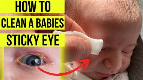Baby Auge Gelber Schleim - Baby Schwanger