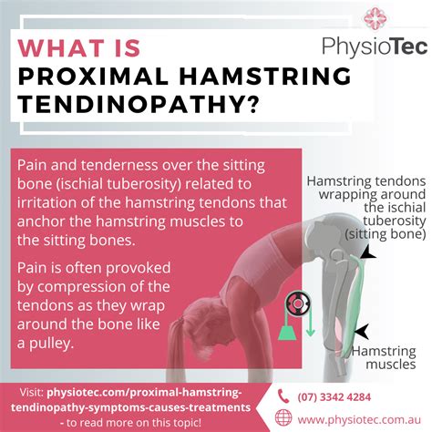Proximal Hamstring Tendinopathy: Symptoms, Causes, Treatments