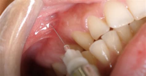 Maxillary Local Anesthesia 的图像结果