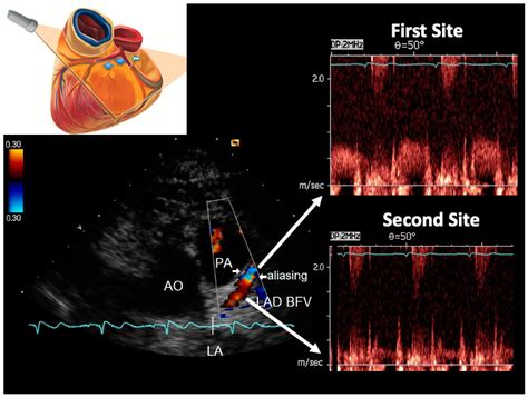 Assessment of the Severity of Left Anterior Descending Coronary Artery ...
