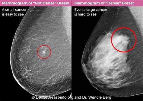 Breast Cancer Mammogram