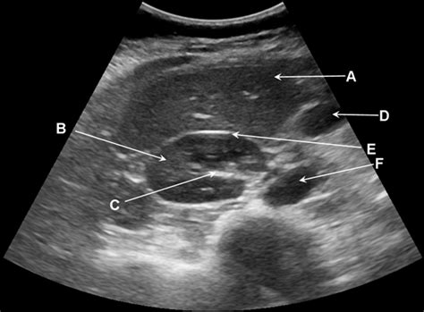 Abdominal Ultrasound Anatomy Abdominal Ultrasound