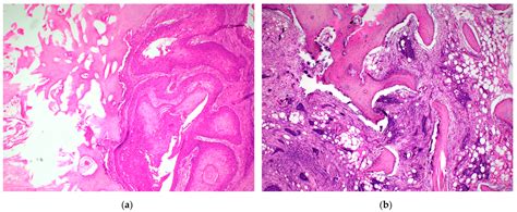 Pattern of Mandibular Bone Invasion as a Prognostic Factor