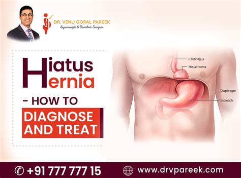 Hiatus hernia - How to diagnose and treat it?