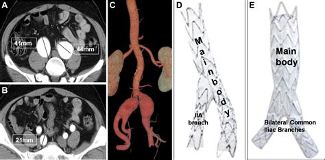 common iliac artery stent placement _ internal iliac artery stenosis ...