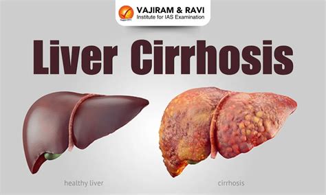 Liver Cirrhosis, Definition, Symptoms, Treatment, Latest News
