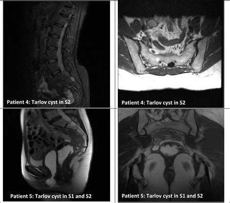 Symptomatic Tarlov cysts: A case series and effectiveness of multimodal rehabilitation plus ...