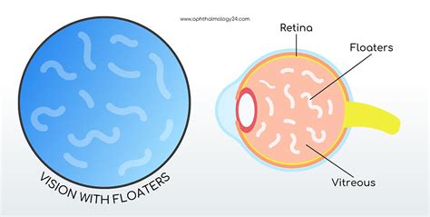 Image result for Eye Floater Types