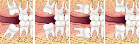The Four Most Common Types of Impacted Wisdom Teeth | Oral and ...