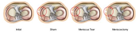 Image result for Activator Method Testing Meniscus