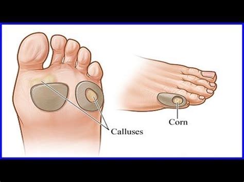 Image result for How to Remove Calluses From Feet Fast