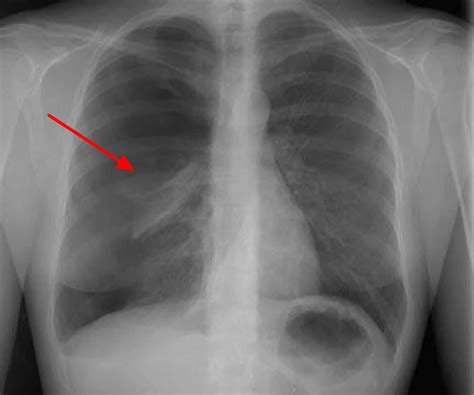 How To Identify Pneumothorax On Chest X Ray at James Urbina blog