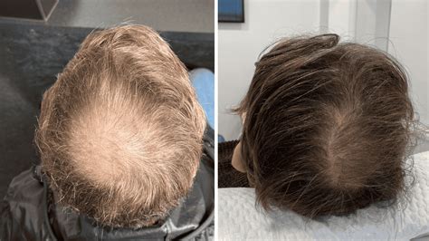 Complete Guide to PRP Hair Treatment: Boosting Your Hair Restoration Results