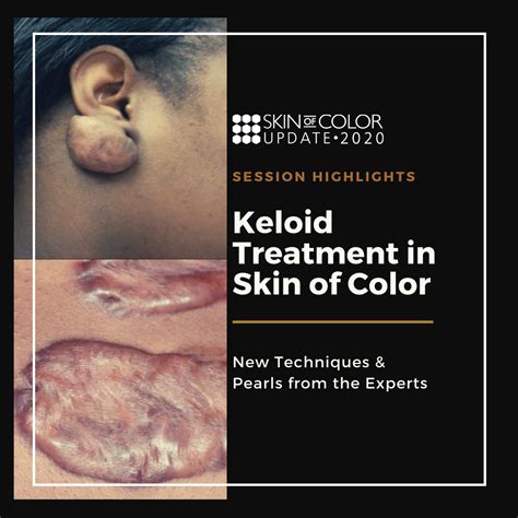 Keloid Treatment in Skin of Color: New Techniques & Pearls from the Experts - Next Steps in ...