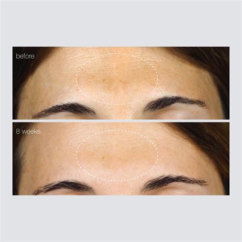 PowerBright Dark Spot Serum — Dermalogica India