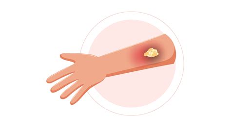 Image result for Removing Carbuncle