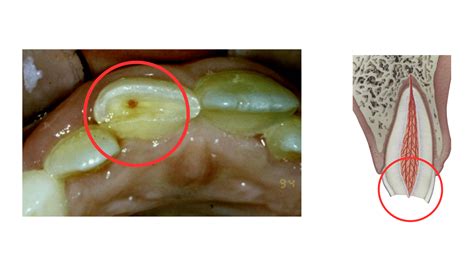 Exposed Tooth Nerves: Causes, Instant Relief, & Treatment Options