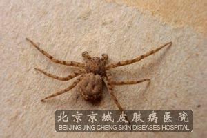 被蜘蛛咬伤的症状有哪些_蛰咬伤_北京京城皮肤医院(北京医保定点机构)