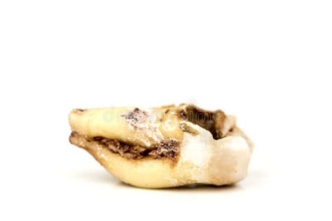 Image result for Wisdom Tooth Decayed