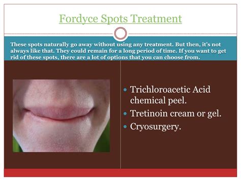 PPT - Fordyce Spots Treatment PowerPoint Presentation, free download - ID:1494291