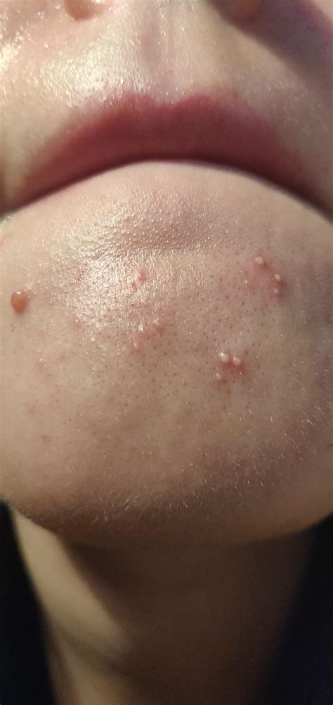White Cyst On Chin Every Type Of Zit, Explained – Cocokind