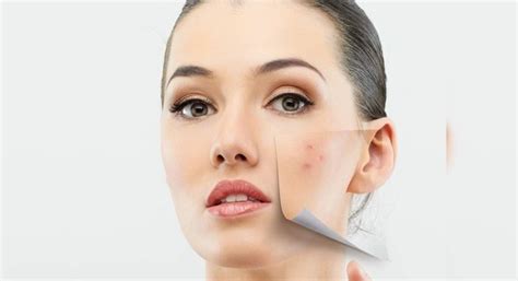 Here's how you can get rid of acne and facial scars - Misskyra.com