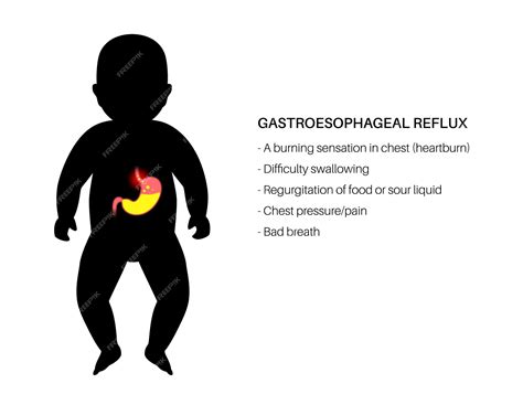 Reflux gastro-œsophagien de la silhouette du nourrisson. Troubles ...