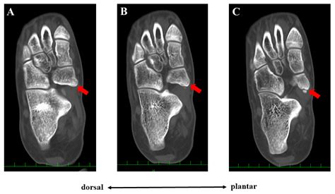 Accessory Navicular A) Image Of Right Foot Showing Localized Erythema