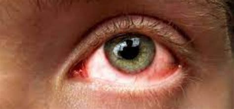Eye Infection: डोळ्यांची आलीये साथ! 'आय इन्फेक्शन'ची लक्षणे, कारणे आणि उपाय