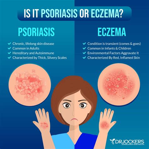 Types of eczema – Artofit