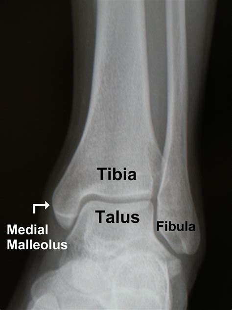 Hairline Fracture X Ray Ankle at Leah Crisp blog