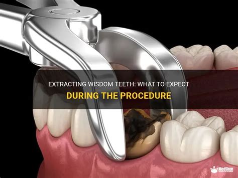 Extracted Wisdom Tooth 的图像结果