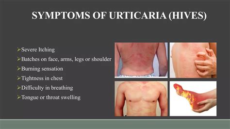 Hives( urticaria) , Cosmetology presentation , | PPTX