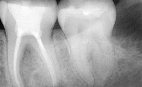 Extracted Wisdom Tooth 的图像结果
