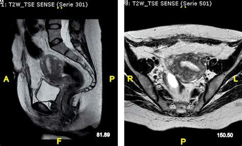 Utero-cutaneous fistula after caesarean section delivery: diagnosis and ...