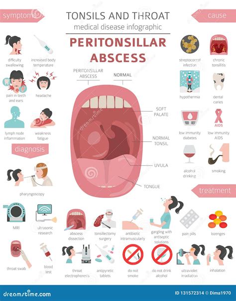 What causes a peritonsillar abscess. Understanding Peritonsillar Abscess: Causes, Symptoms, and ...